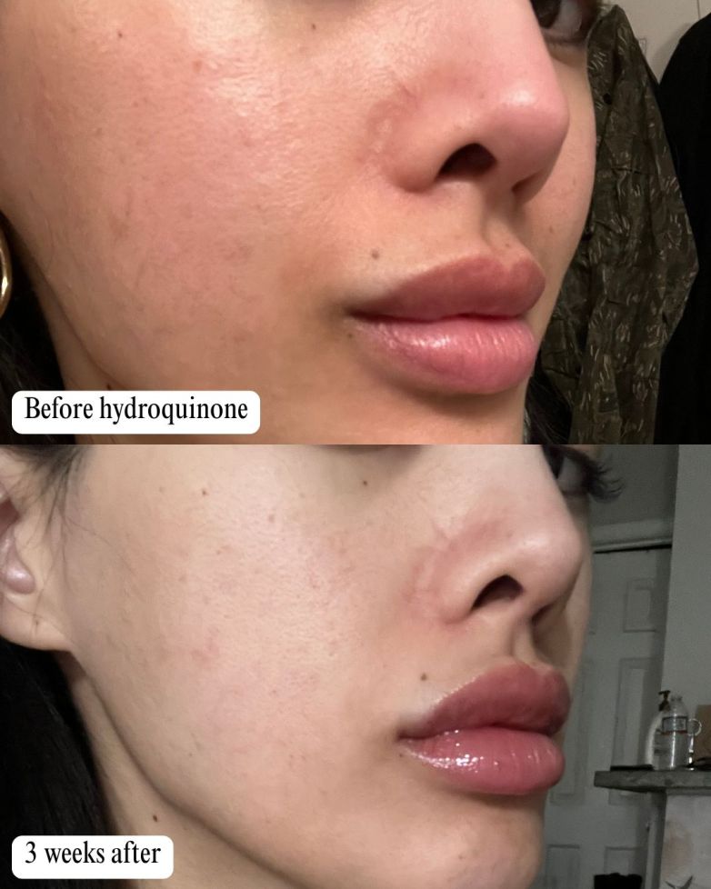 How I Lightened and Evened My Skin + Stopped Wearing Makeup