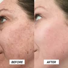 skin lightening journey, hydroquinone before and after, glutathione skin results, Musely Dark Spot Cream review, even skin tone skincare, hyperpigmentation treatment, dark spots removal, glutathione whitening serum, skincare for melasma, how to lighten dark areas on face, best products for skin discoloration, natural glowing skin routine, no makeup confidence, skincare transformation, hormonal pigmentation fix, best cream for uneven skin tone, Korean beauty brightening products