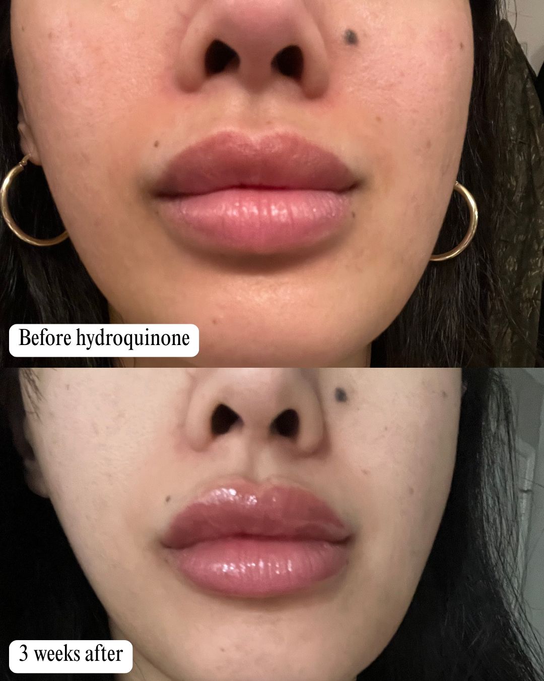 skin lightening journey, hydroquinone before and after, glutathione skin results, Musely Dark Spot Cream review, even skin tone skincare, hyperpigmentation treatment, dark spots removal, glutathione whitening serum, skincare for melasma, how to lighten dark areas on face, best products for skin discoloration, natural glowing skin routine, no makeup confidence, skincare transformation, hormonal pigmentation fix, best cream for uneven skin tone, Korean beauty brightening products