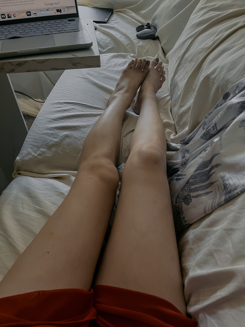 Getting Rid Of My Spider Veins Forever: My Sclerotherapy Experience 